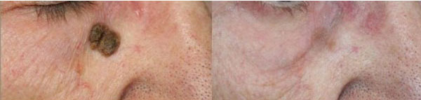 cheratosi seborroiche trattamento laser co2 - Skin Center Centro Laser Dermoestetico Pescara