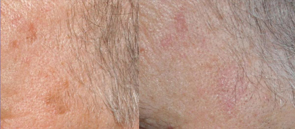 cheratosi seborroiche trattamento laser co2 - Skin Center Centro Laser Dermoestetico Pescara