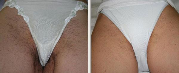 epilazione progressiva - Skin Center Centro Laser Dermoestetico Pescara