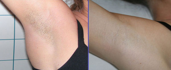 epilazione progressiva - Skin Center Centro Laser Dermoestetico Pescara