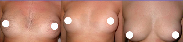 epilazione progressiva - Skin Center Centro Laser Dermoestetico Pescara