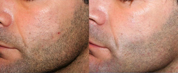 epilazione progressiva - Skin Center Centro Laser Dermoestetico Pescara