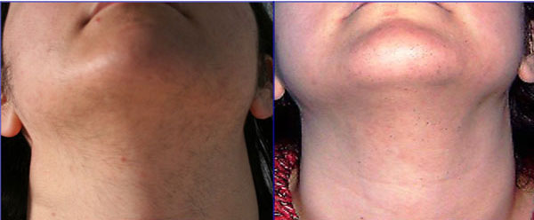 irsutismo - Skin Center Centro Laser Dermoestetico Pescara