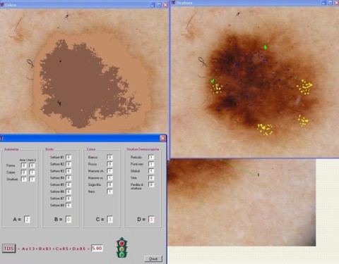 Diagnosi computer assistita di una lesione pigmentata cutanea con il Software Nevuscreen