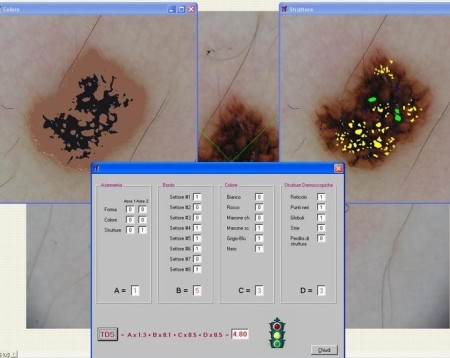 Diagnosi computer assistita di una lesione pigmentata cutanea con il Software Nevuscreen