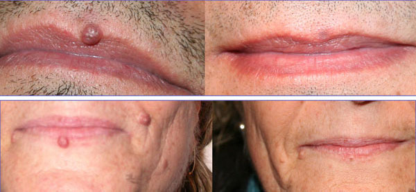 nevo papillomatoso - Skin Center Centro Laser Dermoestetico Pescara