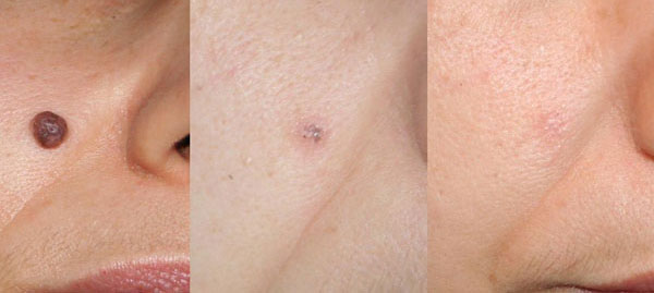 nevo papillomatoso - Skin Center Centro Laser Dermoestetico Pescara