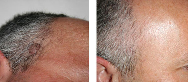 nevo papillomatoso - Skin Center Centro Laser Dermoestetico Pescara