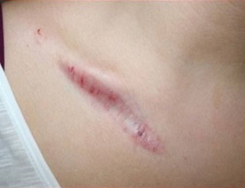 Before-trattamento cicatrici e cheloidi