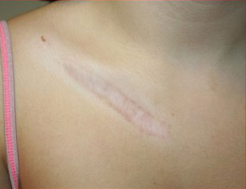 After-trattamento cicatrici e cheloidi