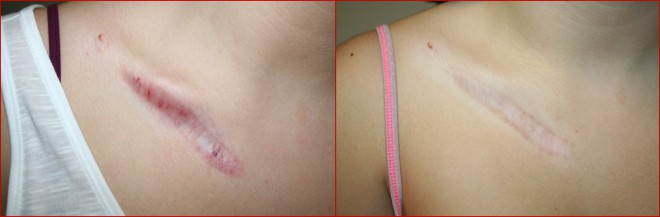 domenico piccolo skin center trattamento cicatrici e cheloidi