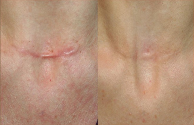 domenico piccolo skin center trattamento cicatrici e cheloidi