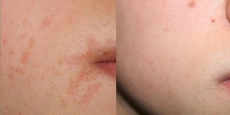 skin center domenico piccolo laser chirurgia cutanea