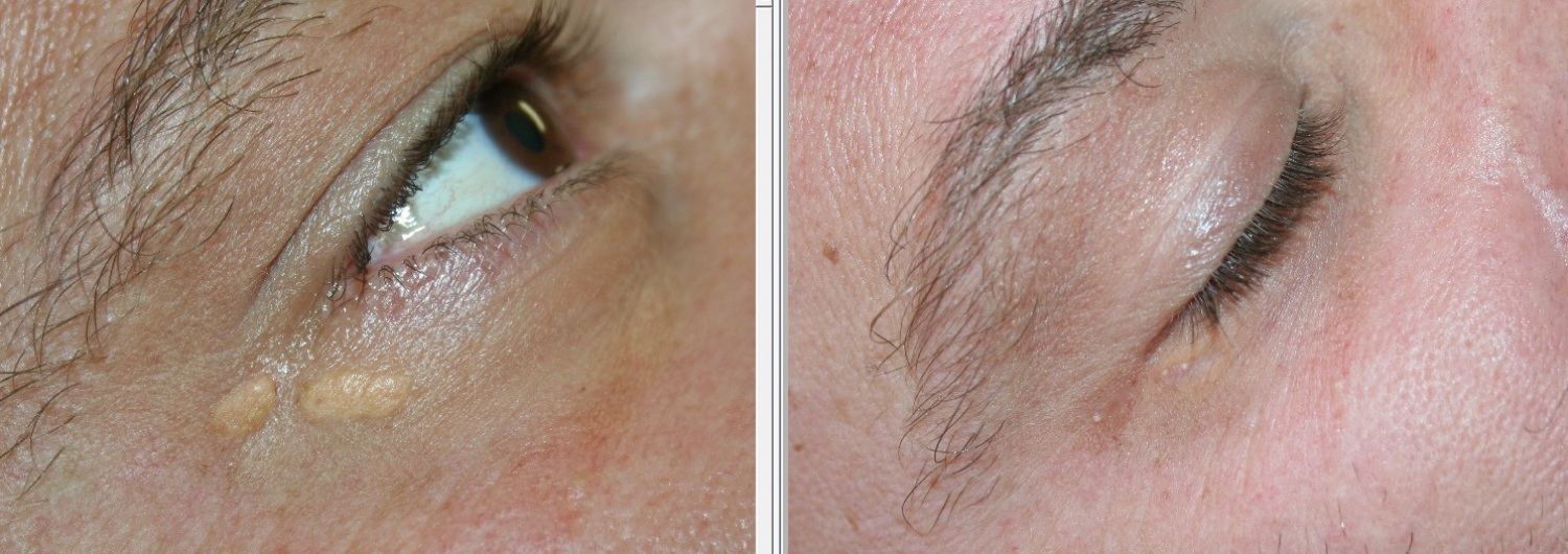 skin center domenico piccolo laser chirurgia cutanea