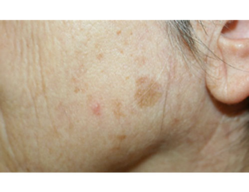 Before-Macchie e melasma