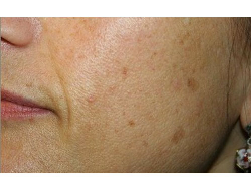 Before-Macchie e melasma