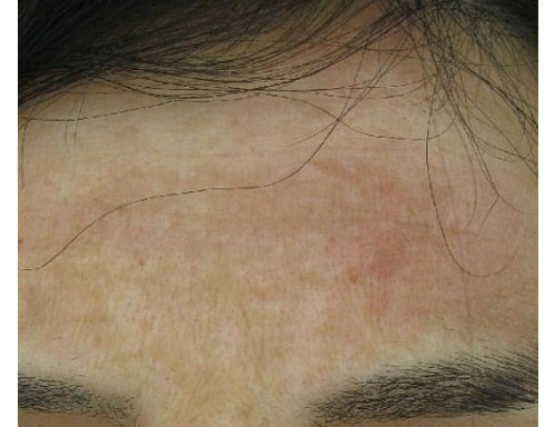 Before-Macchie e melasma