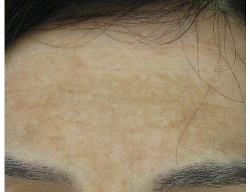 After-Macchie e melasma