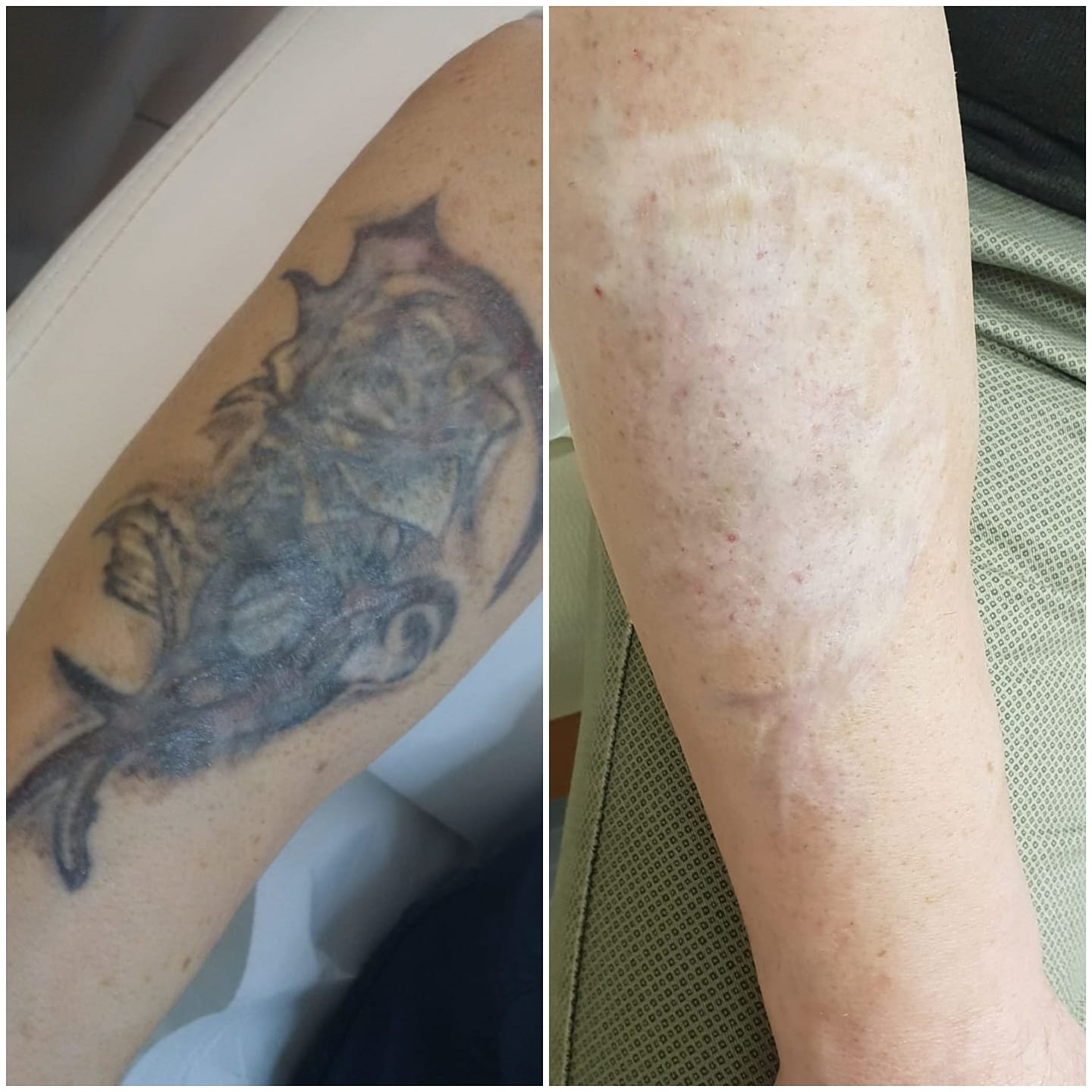 rimozione tatuaggio - skin center centro laser dermoestetico